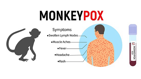 What is monkeypox? Should you be worried? 