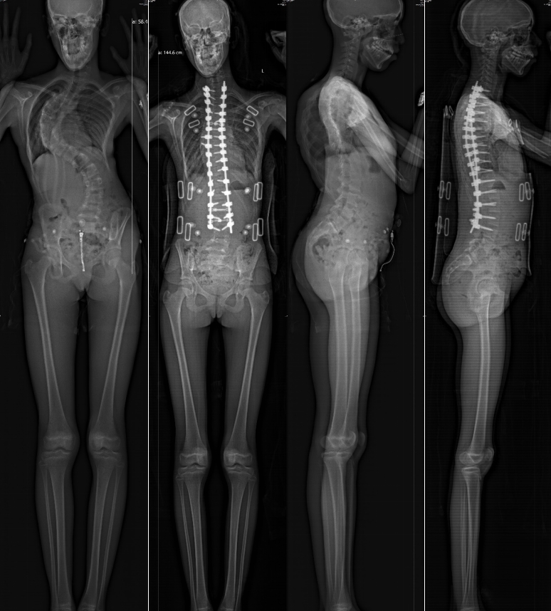 British girl stands tall after scoliosis surgery in Shanghai.png